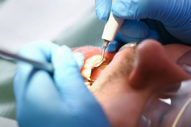 Best Dental Abscess Treatment in Fairmount, GA